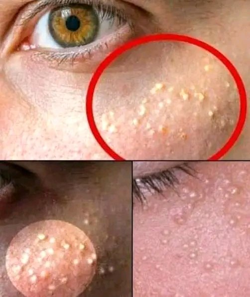 When these little white bumps appear on your skin, it means that…
